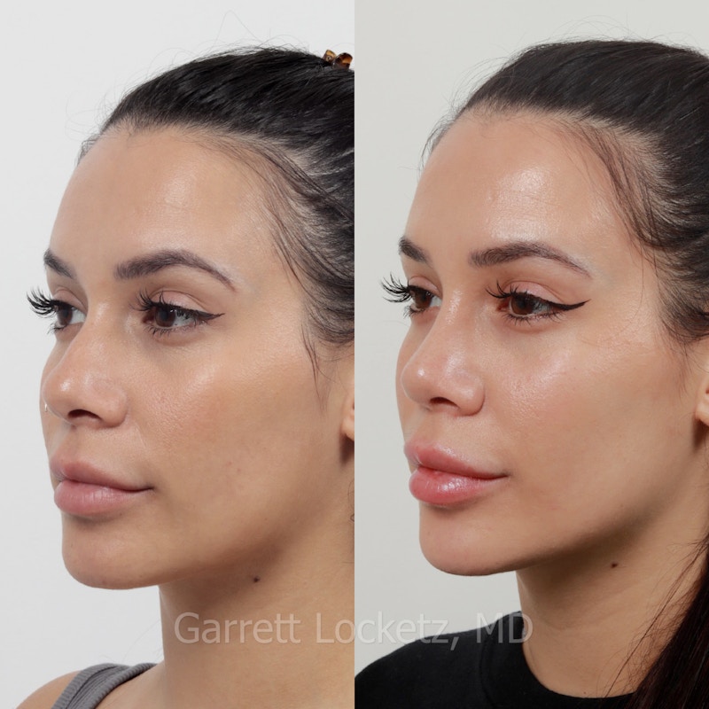 Rhinoplasty Before & After Gallery - Patient 197505970 - Image 1