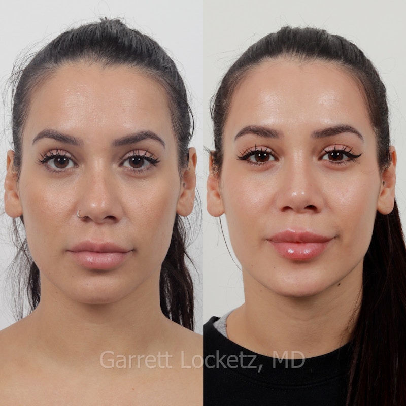 Rhinoplasty Before & After Gallery - Patient 197505971 - Image 1