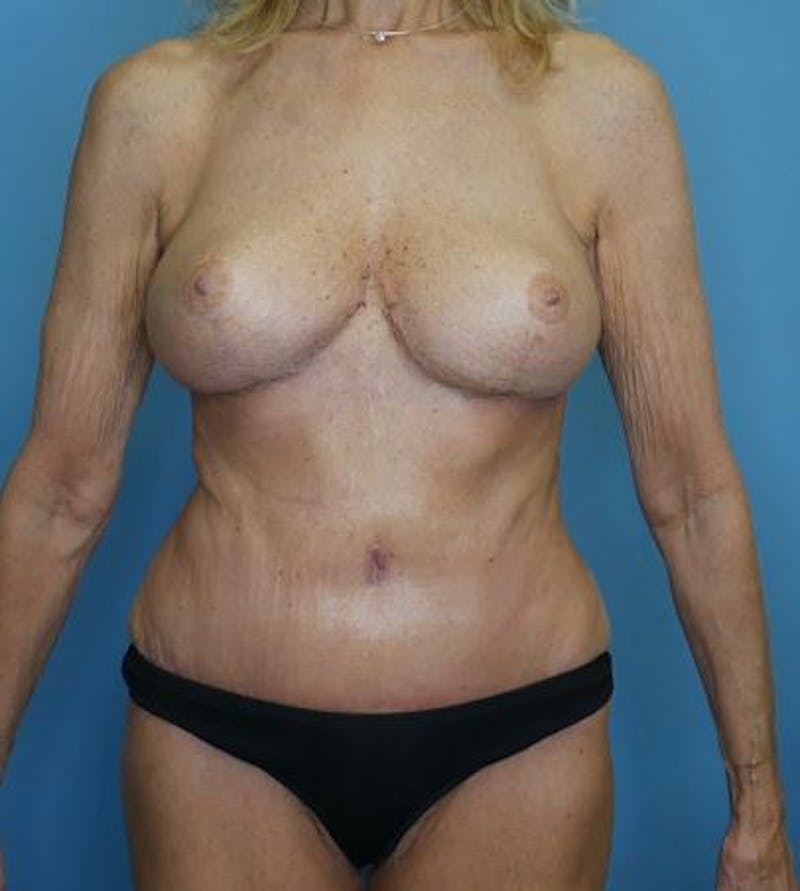 Mommy Makeover Before & After Gallery - Patient 637698 - Image 2