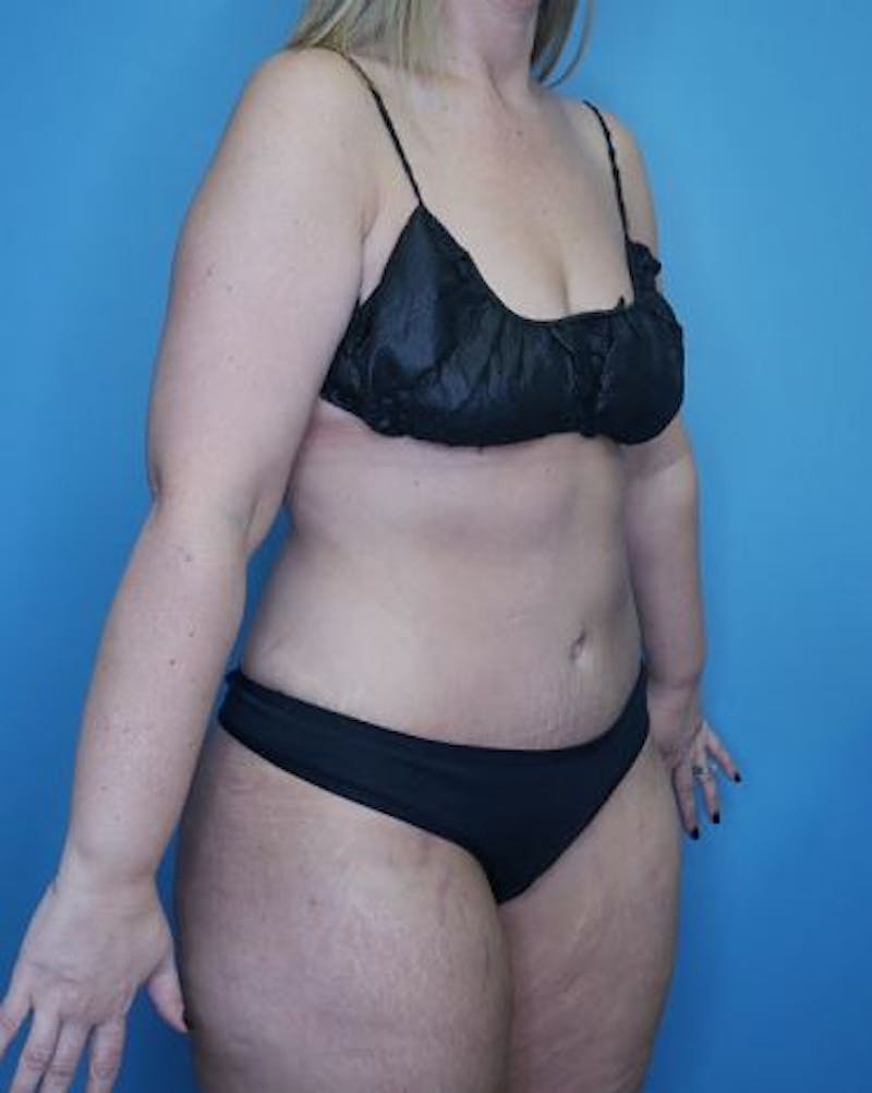 Tummy Tuck (Abdominoplasty)  Before & After Gallery - Patient 133182832 - Image 6