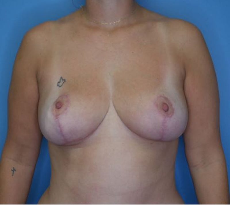 Mommy Makeover Before & After Gallery - Patient 112359 - Image 6