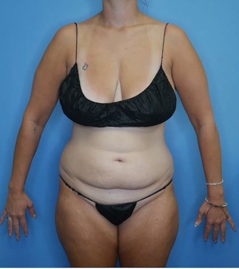 Tummy Tuck (Abdominoplasty)  Before & After Gallery - Patient 356225 - Image 1