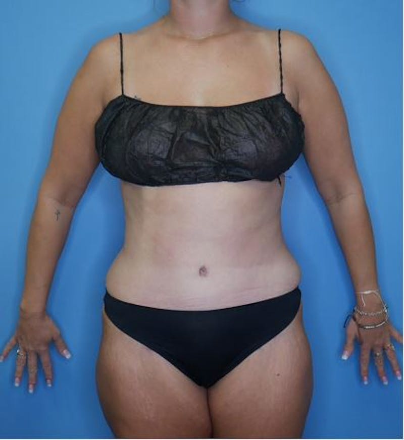 Mommy Makeover Before & After Gallery - Patient 112359 - Image 2