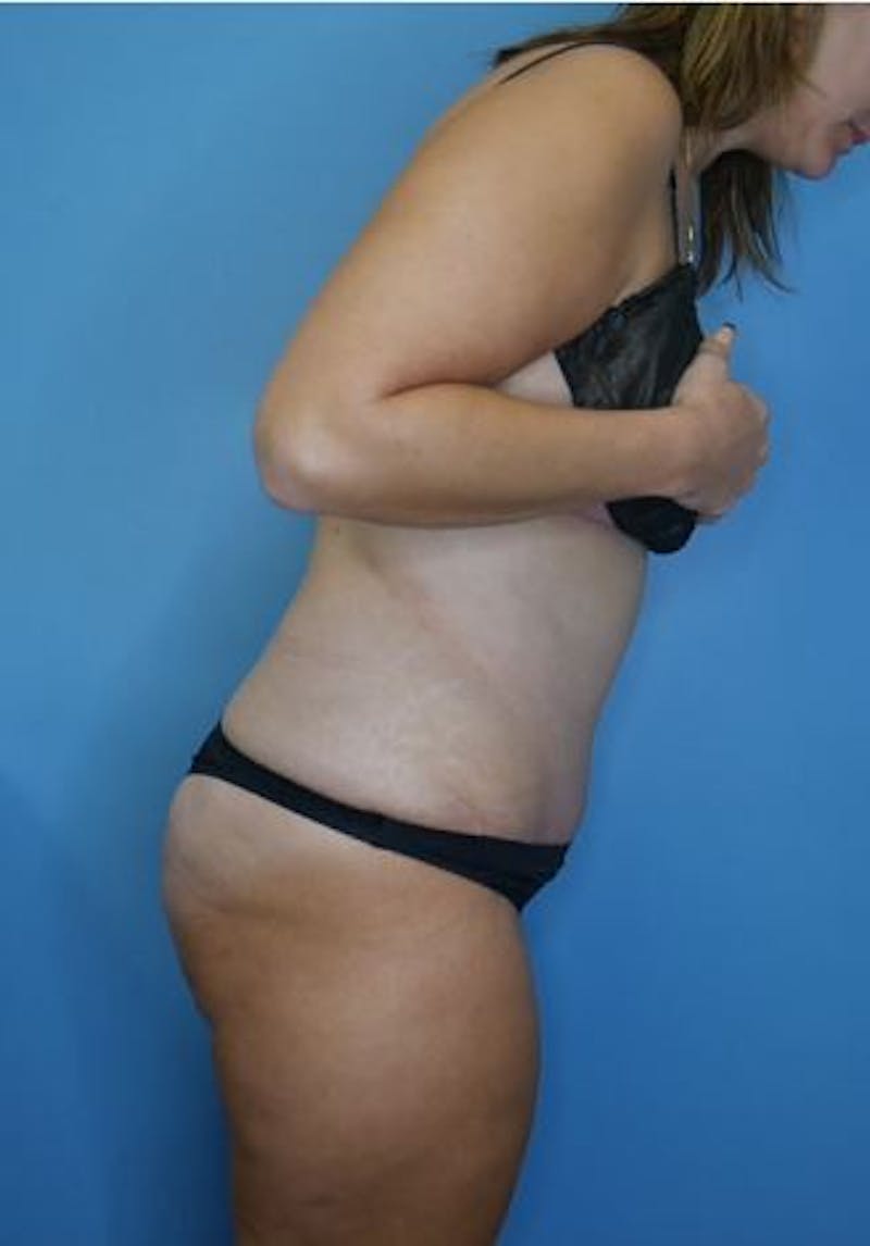 Tummy Tuck (Abdominoplasty)  Before & After Gallery - Patient 356225 - Image 4