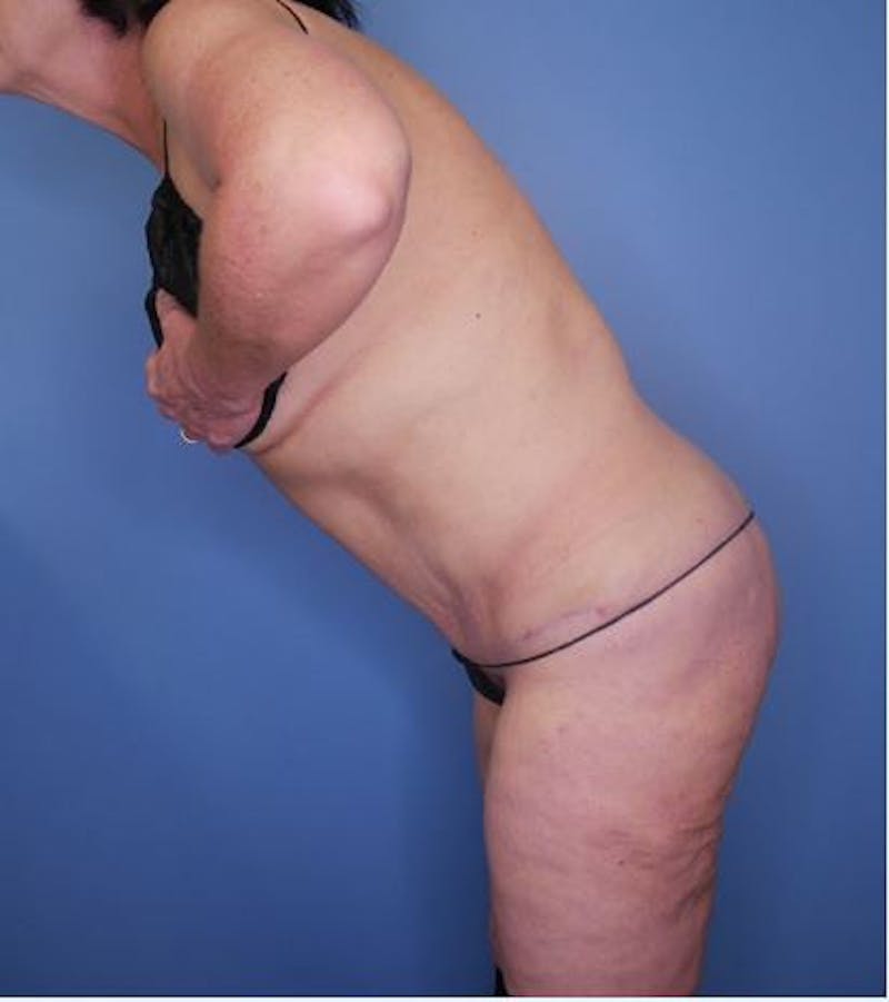 Tummy Tuck (Abdominoplasty)  Before & After Gallery - Patient 171900 - Image 4