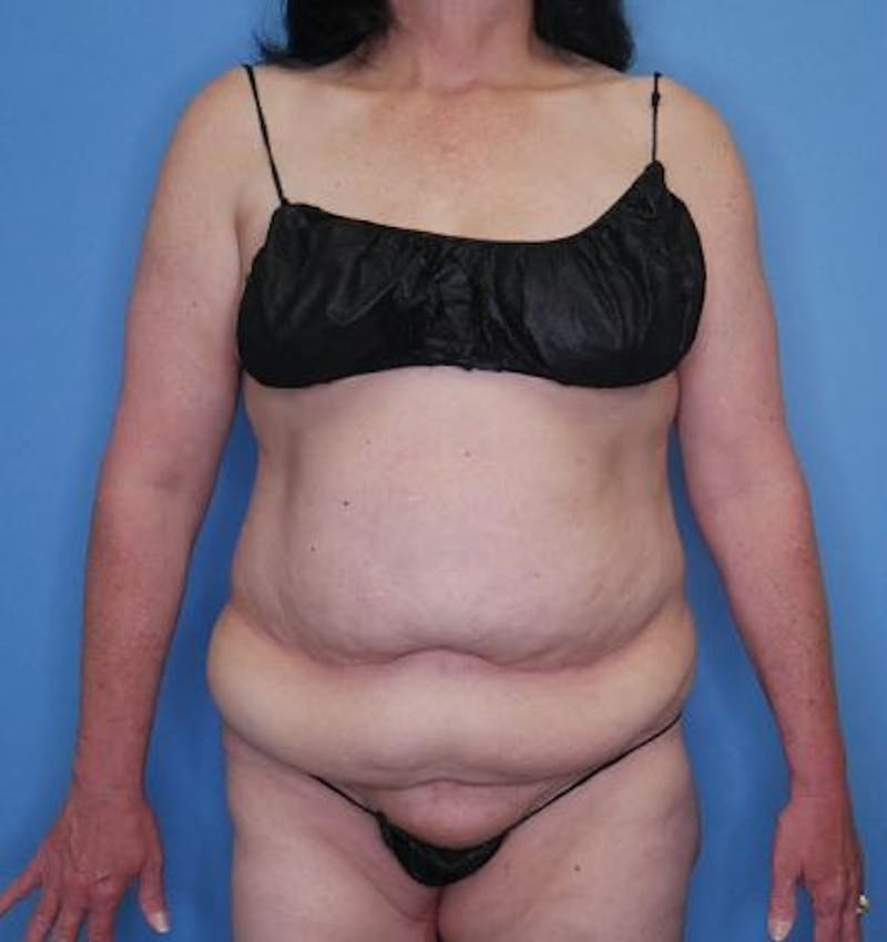 Tummy Tuck (Abdominoplasty)  Before & After Gallery - Patient 171900 - Image 1