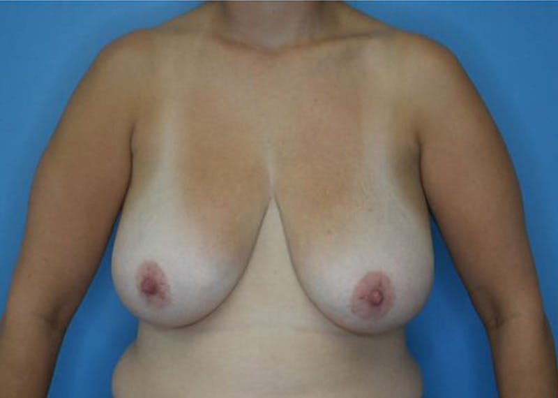 Breast Reduction Before & After Gallery - Patient 185075 - Image 1