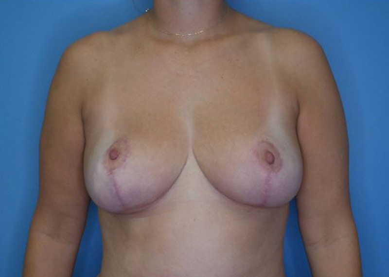 Breast Reduction Before & After Gallery - Patient 185075 - Image 2