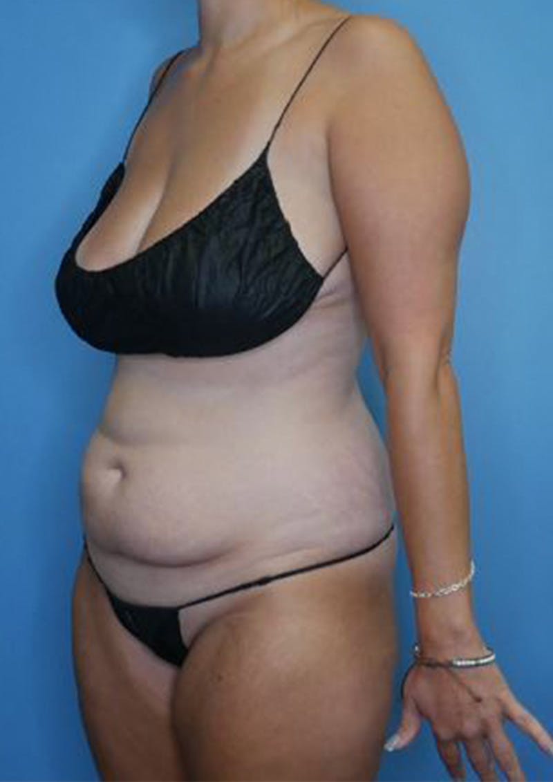 Mommy Makeover Before & After Gallery - Patient 112359 - Image 3