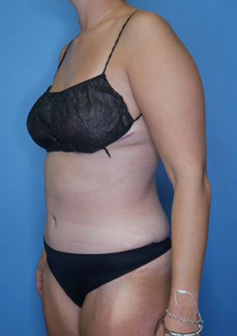 Mommy Makeover Before & After Gallery - Patient 112359 - Image 4