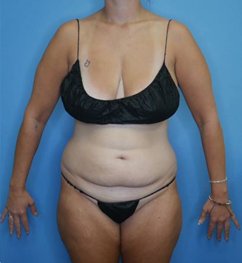 Mommy Makeover Before & After Gallery - Patient 112359 - Image 1
