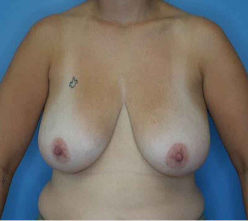 Mommy Makeover Before & After Gallery - Patient 112359 - Image 5