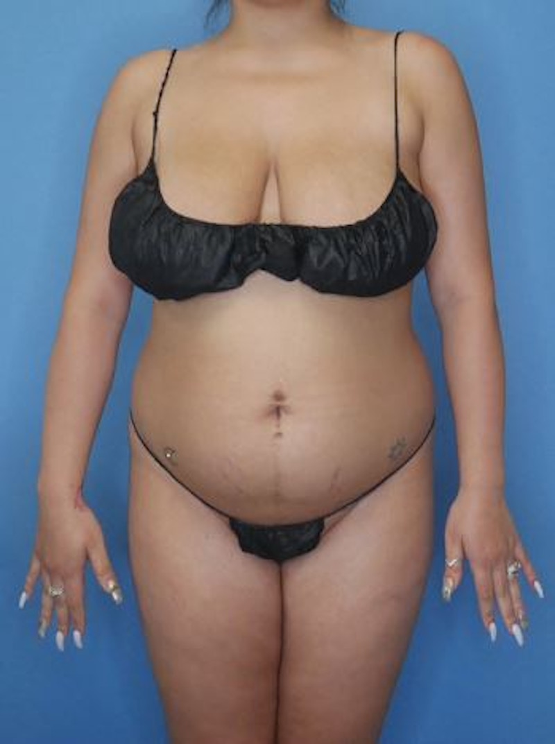 Vaser Liposuction Before & After Gallery - Patient 170650138 - Image 1