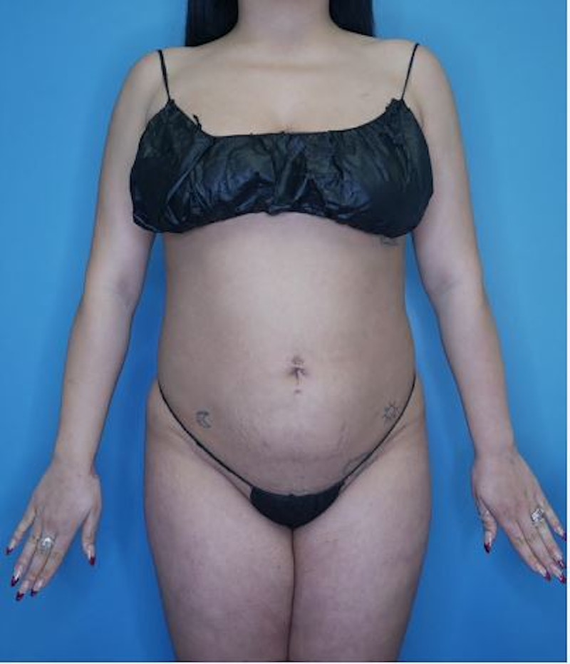 Vaser Liposuction Before & After Gallery - Patient 170650138 - Image 2