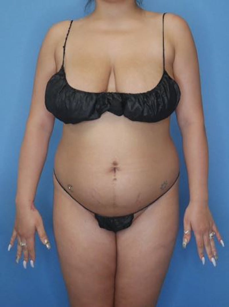 Mommy Makeover Before & After Gallery - Patient 230683 - Image 1