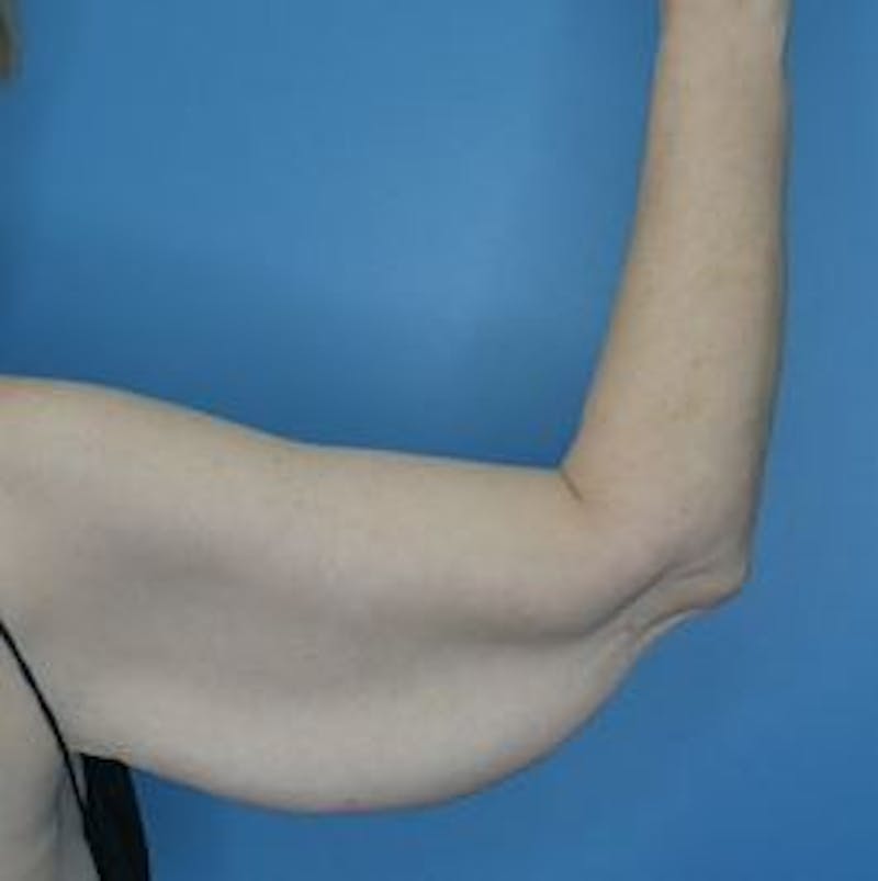 Arm Lift (Brachioplasty)  Before & After Gallery - Patient 206993 - Image 1