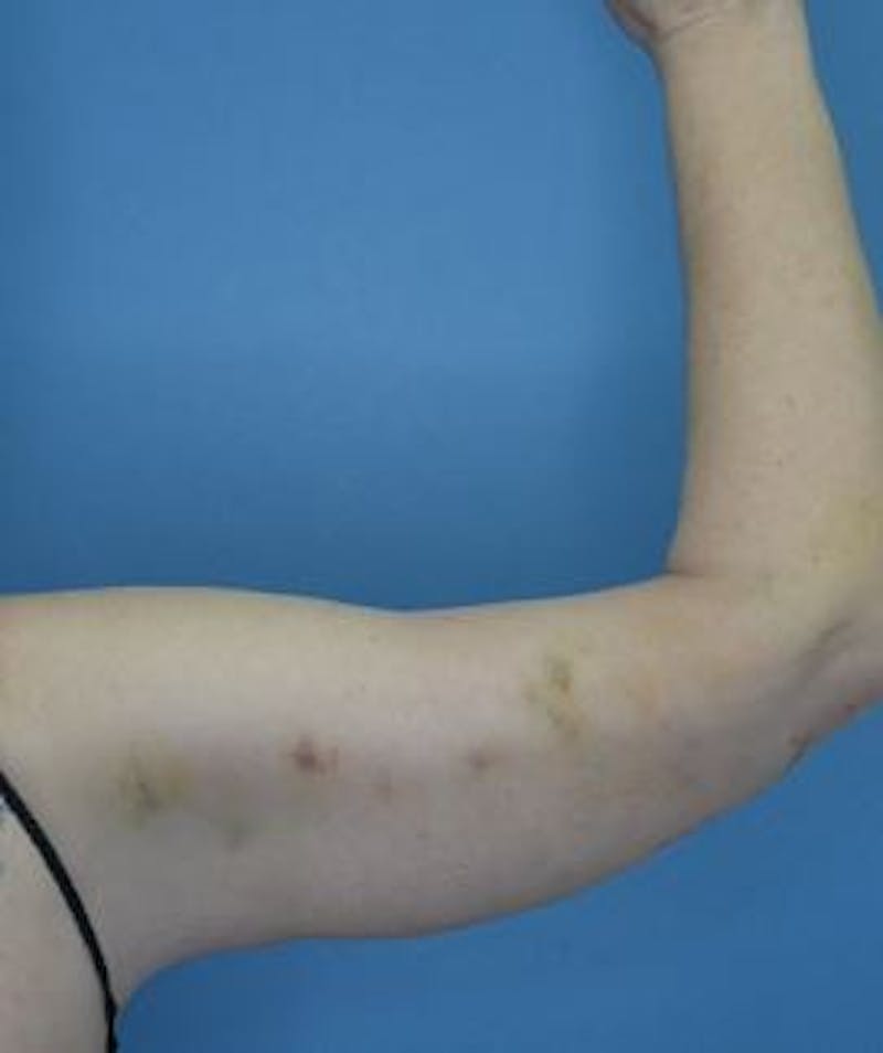 Arm Lift (Brachioplasty)  Before & After Gallery - Patient 206993 - Image 2