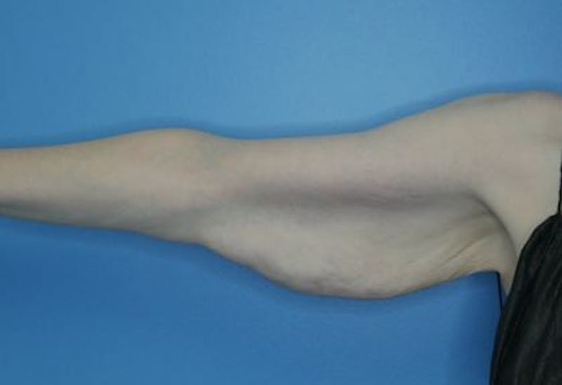 Arm Lift (Brachioplasty)  Before & After Gallery - Patient 206993 - Image 3