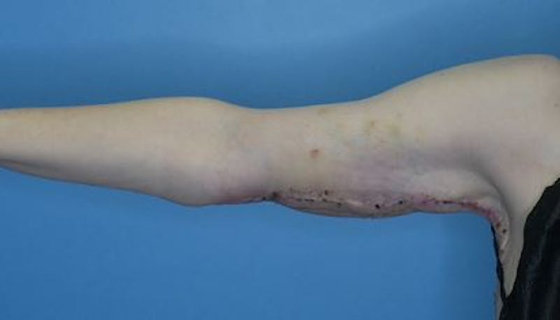 Arm Lift (Brachioplasty)  Before & After Gallery - Patient 206993 - Image 4
