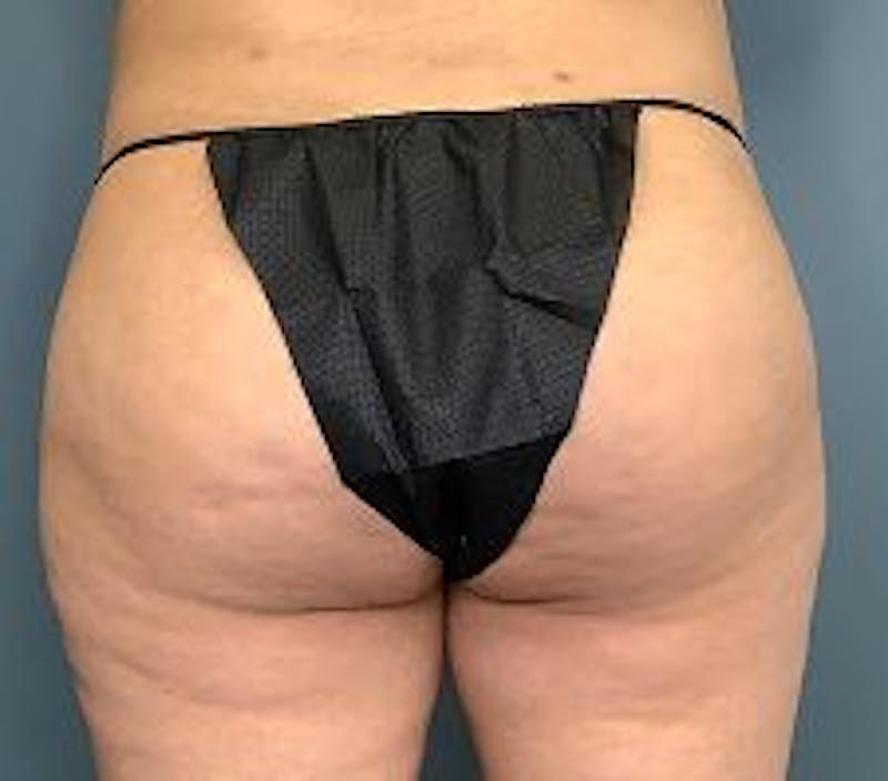 BBL (Brazilian Butt Lift) Before & After Gallery - Patient 363179 - Image 1