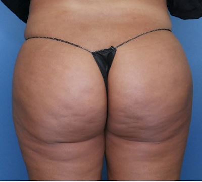 BBL (Brazilian Butt Lift) Before & After Gallery - Patient 363179 - Image 2