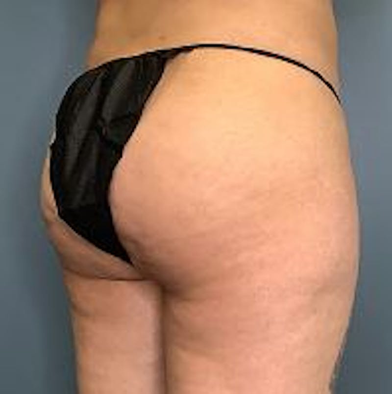 BBL (Brazilian Butt Lift) Before & After Gallery - Patient 363179 - Image 3