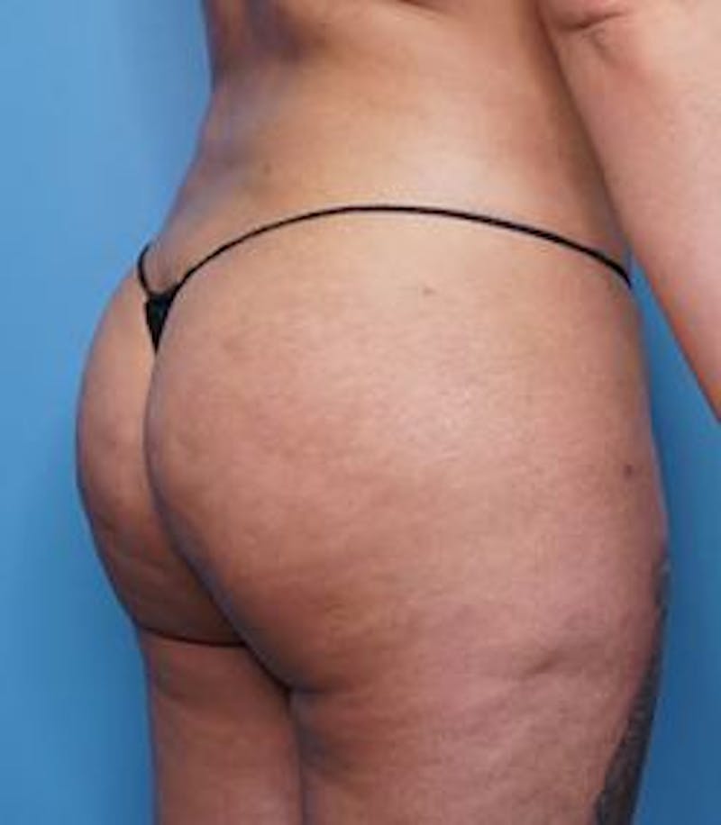 BBL (Brazilian Butt Lift) Before & After Gallery - Patient 363179 - Image 4