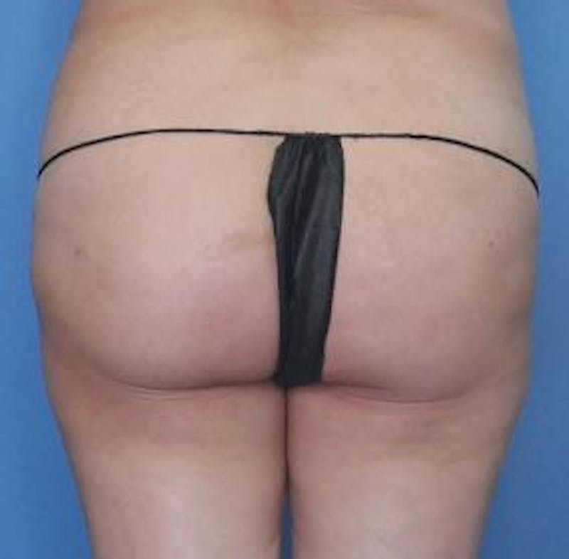 BBL (Brazilian Butt Lift) Before & After Gallery - Patient 232850 - Image 1