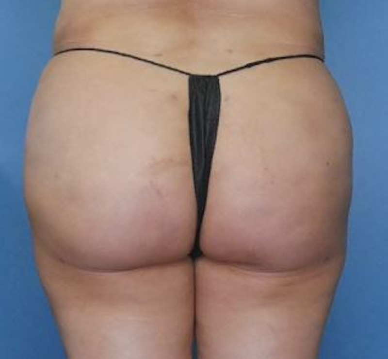 BBL (Brazilian Butt Lift) Before & After Gallery - Patient 232850 - Image 2