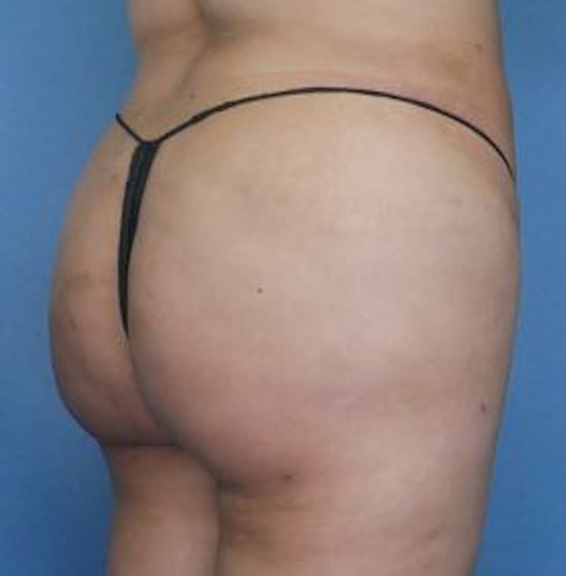 BBL (Brazilian Butt Lift) Before & After Gallery - Patient 232850 - Image 4