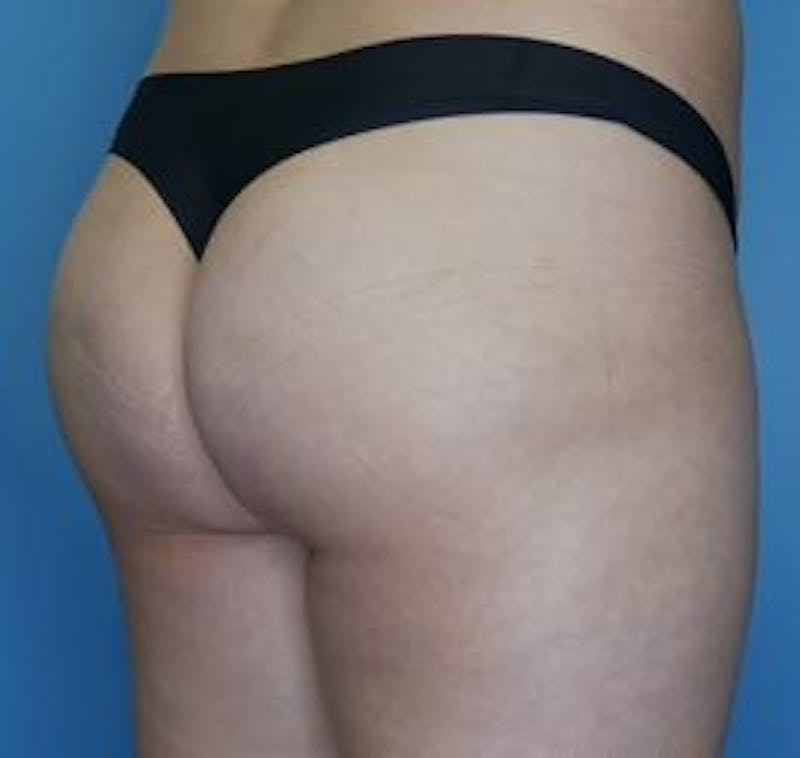 BBL (Brazilian Butt Lift) Before & After Gallery - Patient 354474 - Image 4