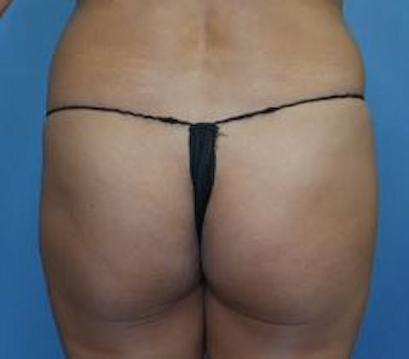 BBL (Brazilian Butt Lift) Before & After Gallery - Patient 286866 - Image 1