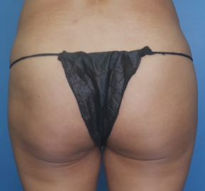 BBL (Brazilian Butt Lift) Before & After Gallery - Patient 286866 - Image 2