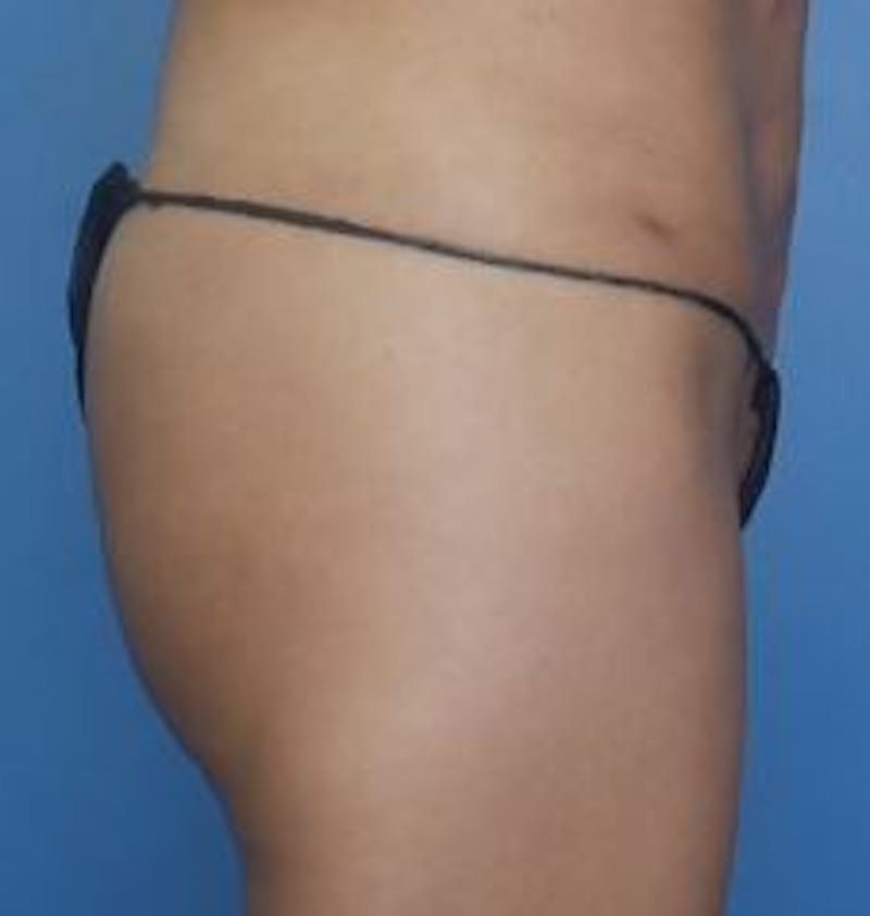 BBL (Brazilian Butt Lift) Before & After Gallery - Patient 286866 - Image 4