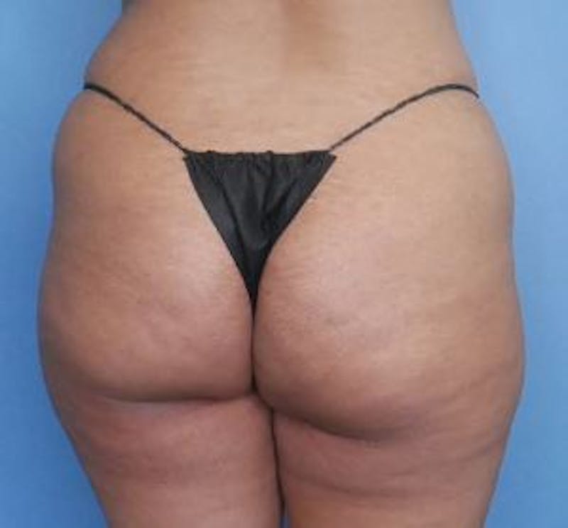 BBL (Brazilian Butt Lift) Before & After Gallery - Patient 320635 - Image 1