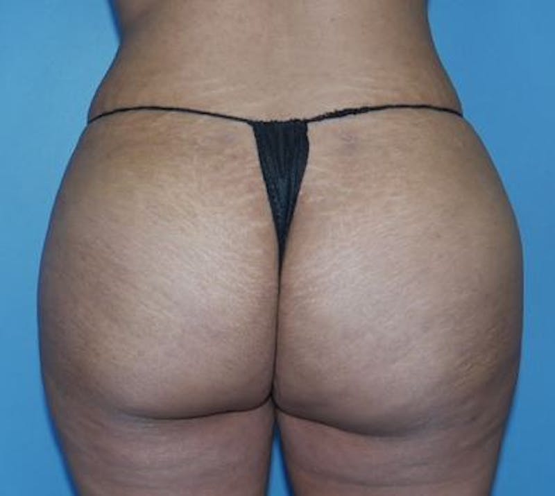 BBL (Brazilian Butt Lift) Before & After Gallery - Patient 320635 - Image 2