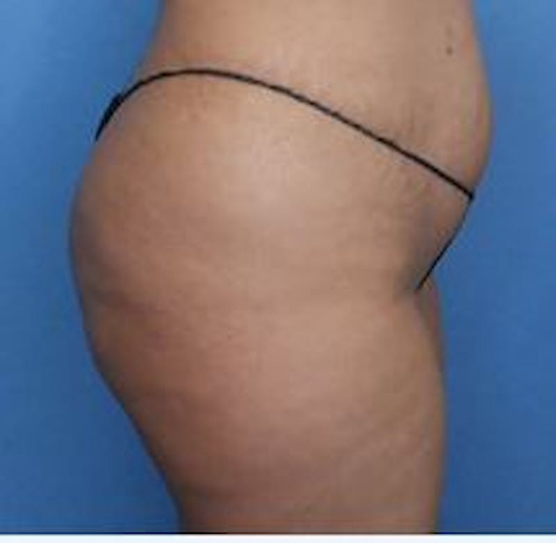 BBL (Brazilian Butt Lift) Before & After Gallery - Patient 320635 - Image 3