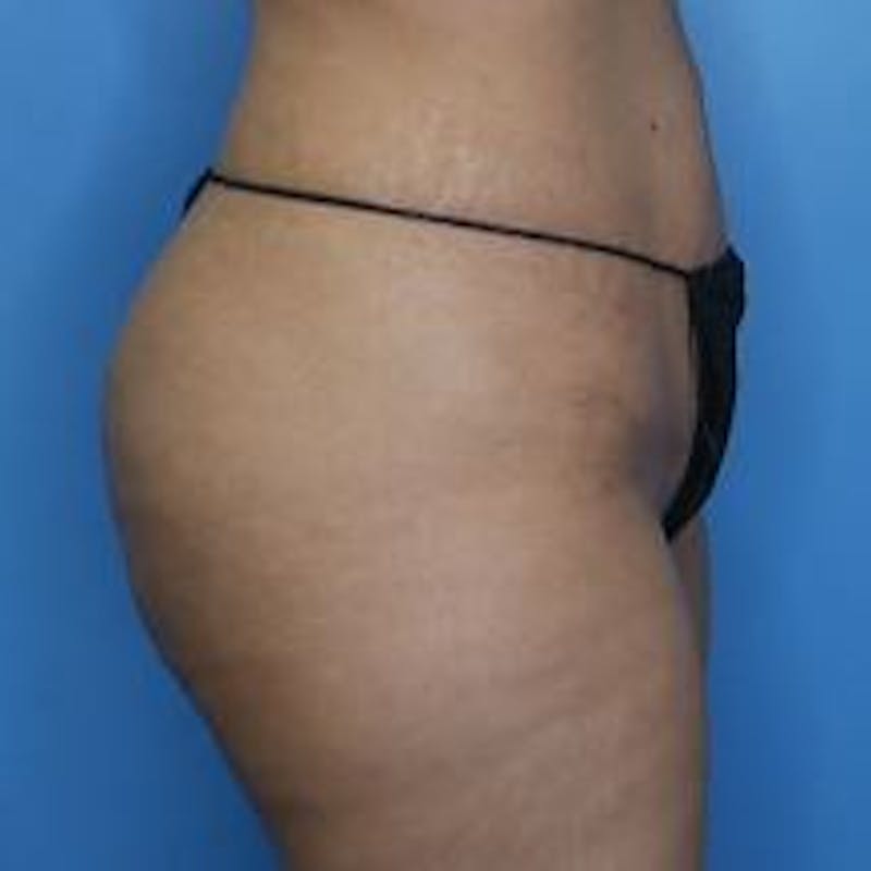 BBL (Brazilian Butt Lift) Before & After Gallery - Patient 320635 - Image 4