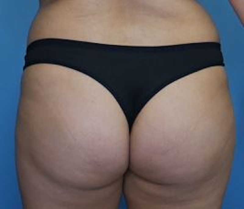 BBL (Brazilian Butt Lift) Before & After Gallery - Patient 142422 - Image 1
