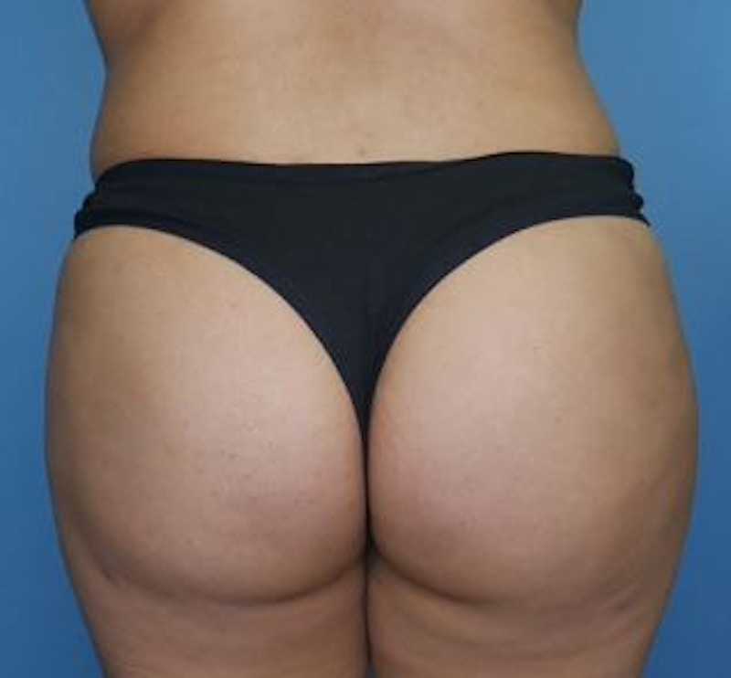 BBL (Brazilian Butt Lift) Before & After Gallery - Patient 142422 - Image 2