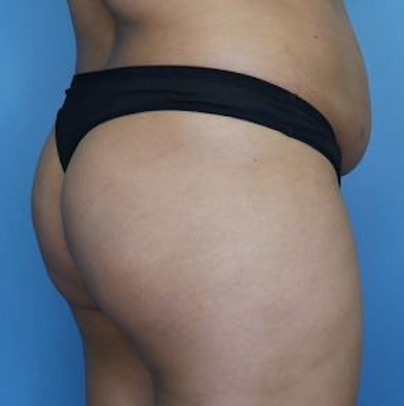 BBL (Brazilian Butt Lift) Before & After Gallery - Patient 142422 - Image 3