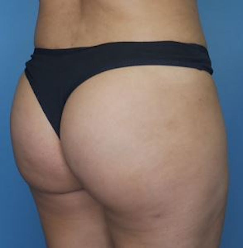 BBL (Brazilian Butt Lift) Before & After Gallery - Patient 142422 - Image 4
