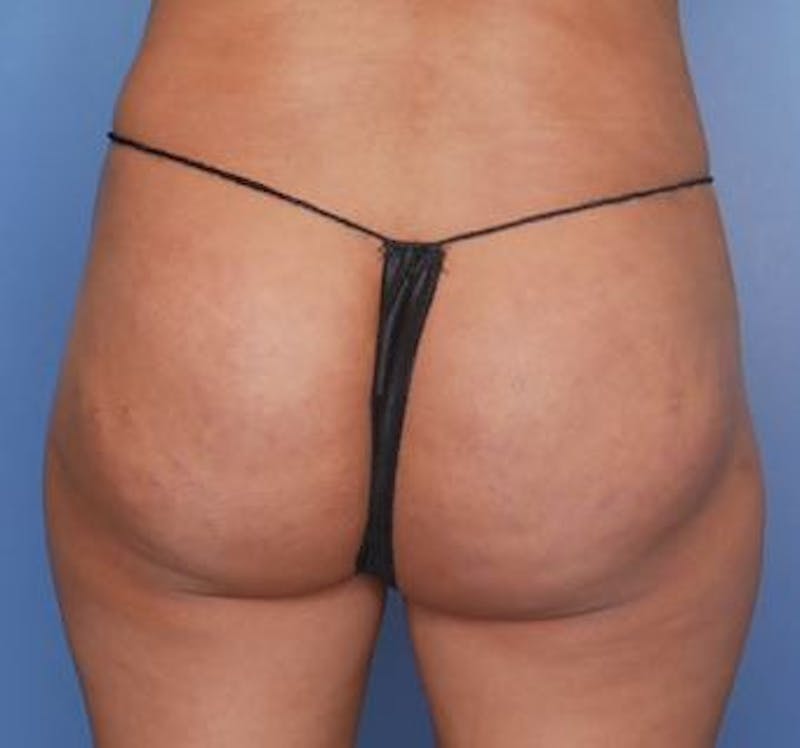 BBL (Brazilian Butt Lift) Before & After Gallery - Patient 282927 - Image 1