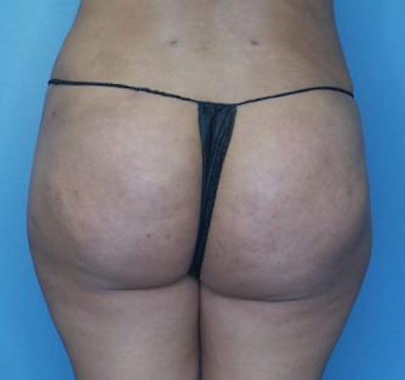 BBL (Brazilian Butt Lift) Before & After Gallery - Patient 282927 - Image 2