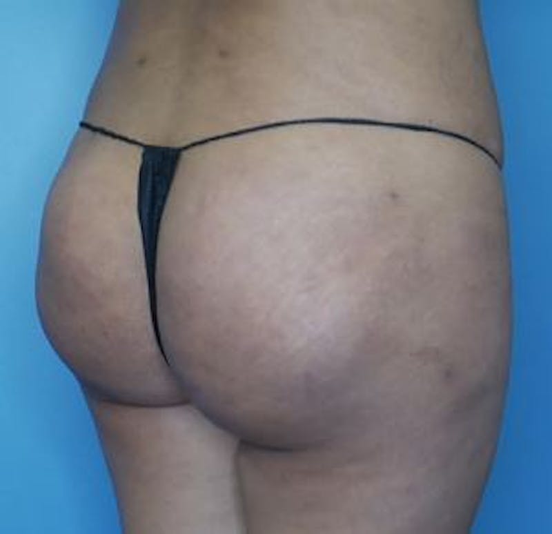 BBL (Brazilian Butt Lift) Before & After Gallery - Patient 282927 - Image 3