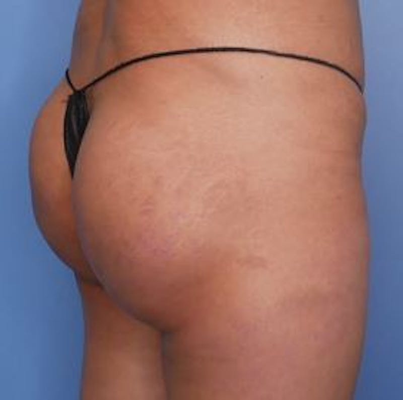 BBL (Brazilian Butt Lift) Before & After Gallery - Patient 282927 - Image 4