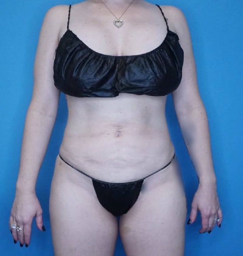 Vaser Liposuction Before & After Gallery - Patient 265282 - Image 2