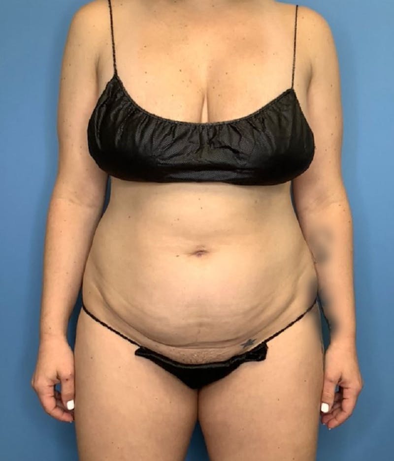 Vaser Liposuction Before & After Gallery - Patient 265282 - Image 1