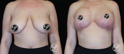 Breast Before & After Gallery - Patient 9630849 - Image 1