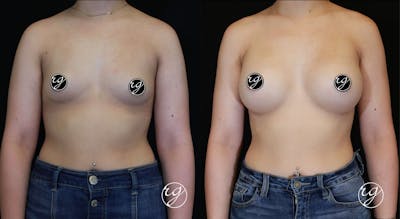 Breast Before & After Gallery - Patient 9630850 - Image 1